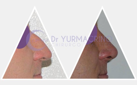 Men Rhinoplasty – Case 3/B