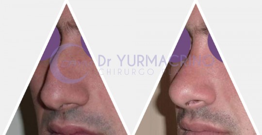 Men Rhinoplasty – Case 4/A