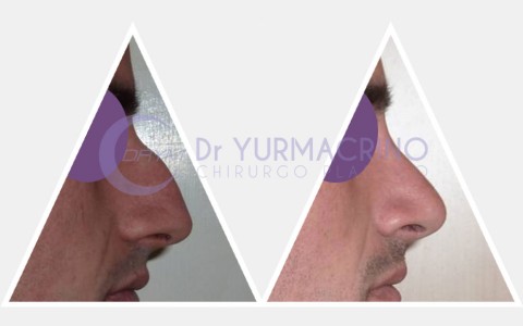 Men Rhinoplasty – Case 4/B