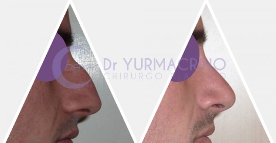 Men Rhinoplasty – Case 4/B