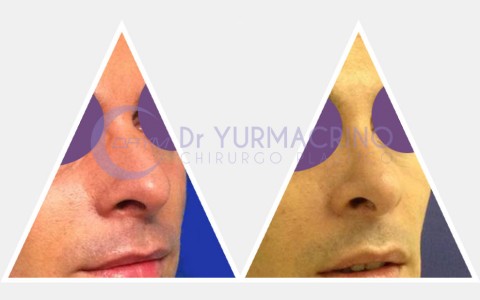 Men Rhinoplasty – Case 5/A