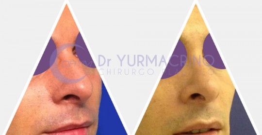 Men Rhinoplasty – Case 5/A