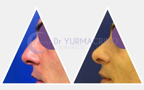 Men Rhinoplasty – Case 5/B