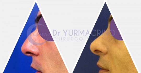 Men Rhinoplasty – Case 5/B