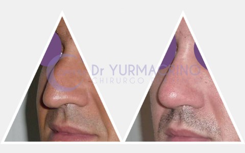 Men Rhinoplasty – Case 6/A