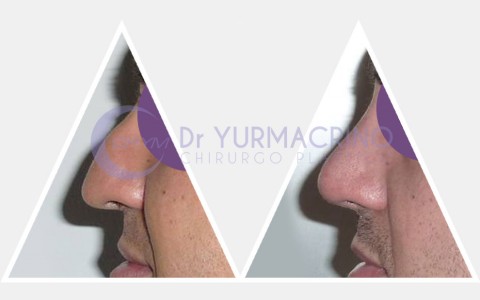 Men Rhinoplasty – Case 6/B