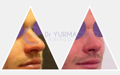 Men Rhinoplasty – Case 7/A