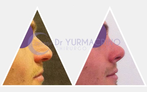 Men Rhinoplasty – Case 7/B